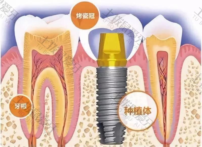 奥齿泰种植牙怎么样