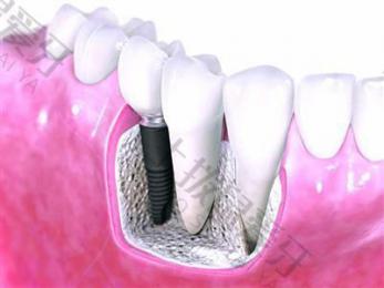 种植牙的一般费用 种植牙寿命是多少年