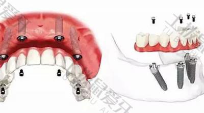 种植牙手术需要多长时间完成 种植牙手术需要多长时间恢复