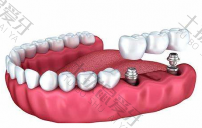 种植牙最快多长时间 种植牙手术后多久消肿和不痛