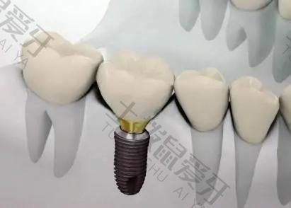 种植牙手术后会痛多久