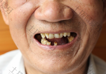 老人牙掉了是嵌上假牙好还是种植牙好 种植牙的寿命和费用