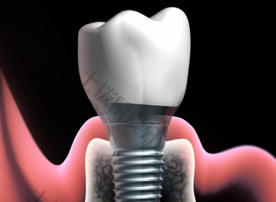 种植牙基台种类