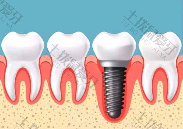 种植牙基台种类