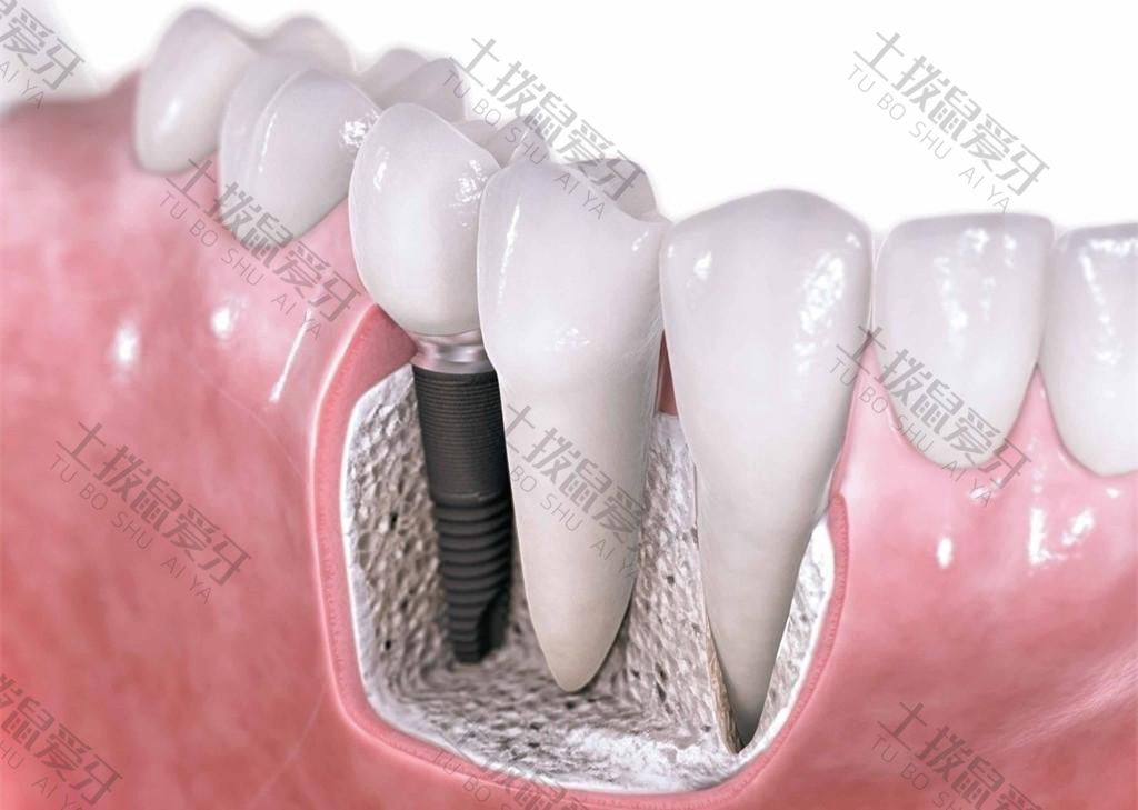 种植牙要做几次手术完成