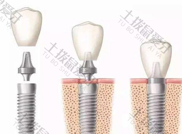 门牙植牙过程是怎样的