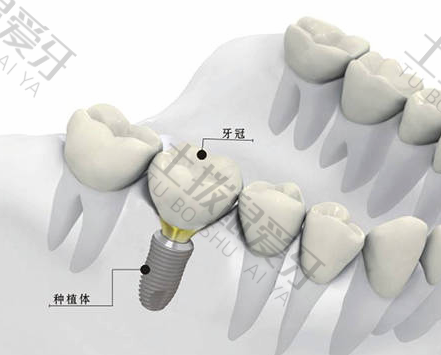 种植牙材料有什么区别