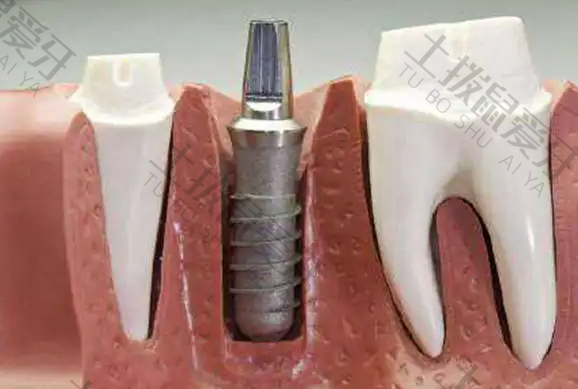 种植牙的牙齿是什么材料
