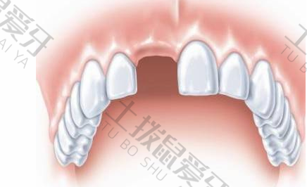 门牙种植牙过程中的影响上班吗