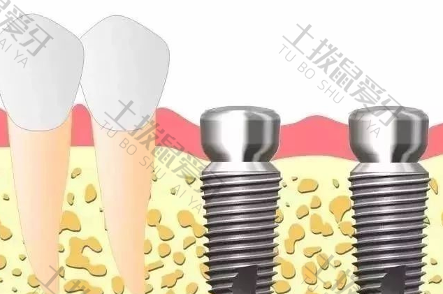 种植牙装基台疼吗