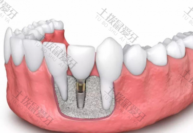 种植牙费用包含哪些 种植牙的步骤和过程
