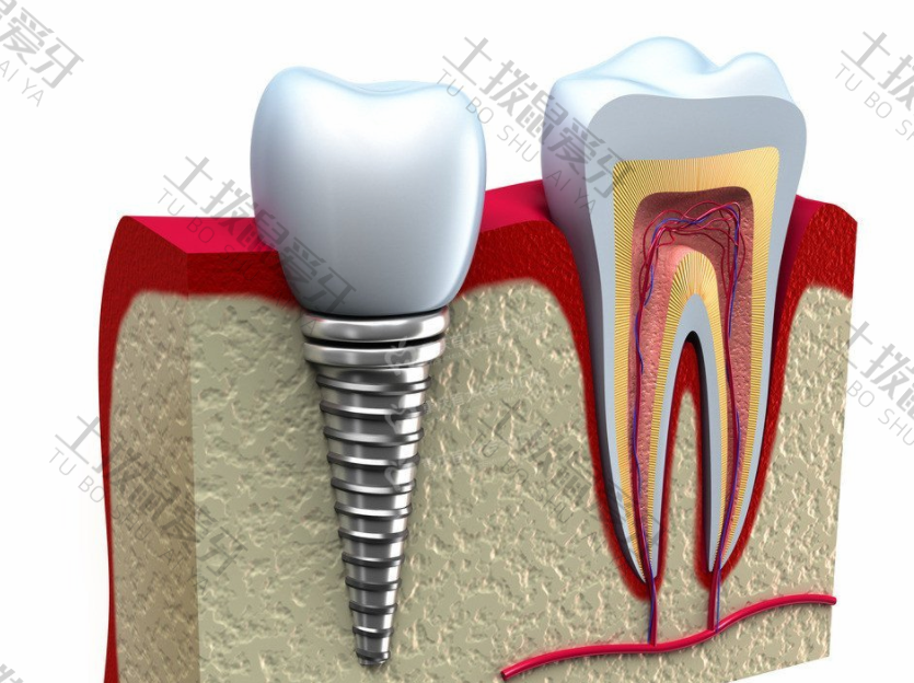 种植牙齿修复的方法