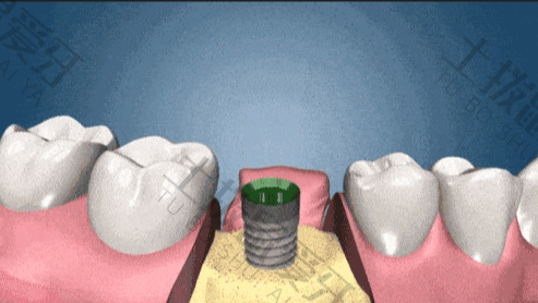 植牙对牙槽骨的要求是什么