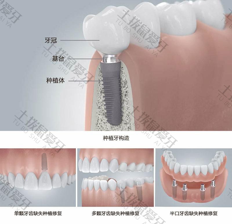 种植牙齿修复的方法