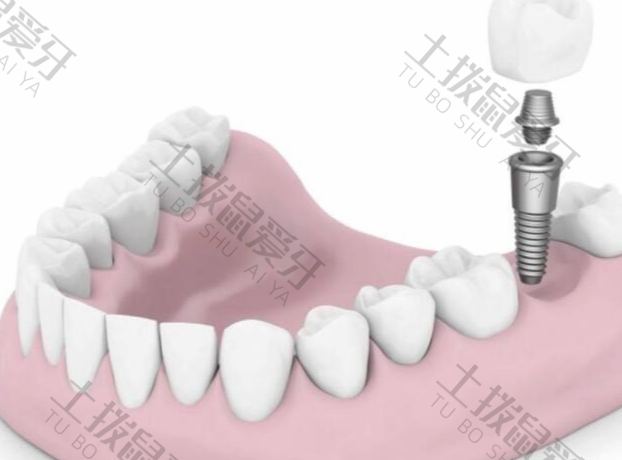 种植牙的原理和步骤