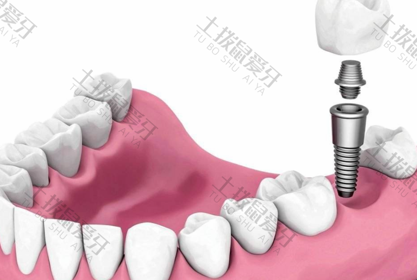 种植牙的原理和步骤
