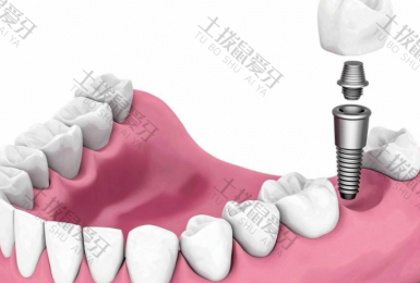 种植牙的原理和步骤 种植牙的维护方法
