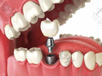 种植牙槽骨分类 牙槽骨和种植体是怎样结合的