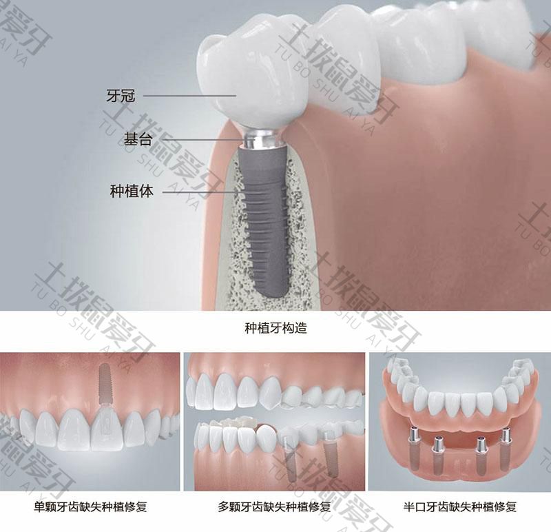 种植牙的材料及价格