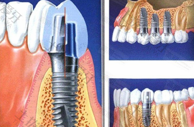 种植牙的材料及价格
