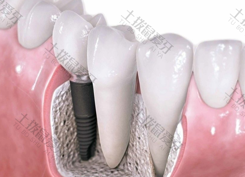 种植牙过程一般多长时间