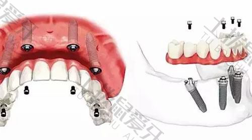 满口种植牙一般多少钱