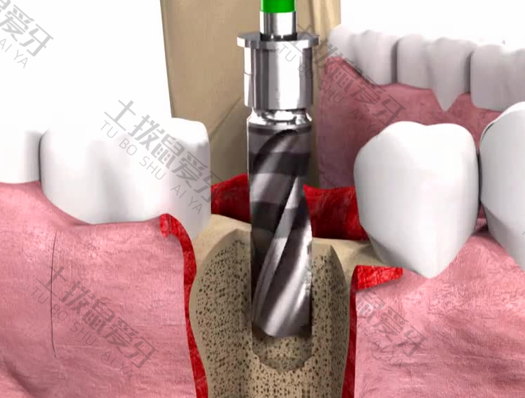 种植牙过程痛苦吗