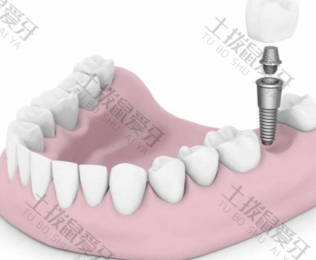 种植牙过程受罪吗 种植牙过程分为几个步骤