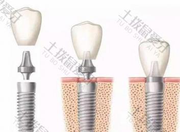 美国种植牙品牌有哪些 韩国进口种植牙品牌有哪几种