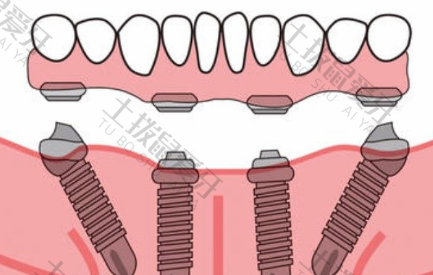 全口种植牙种几颗 