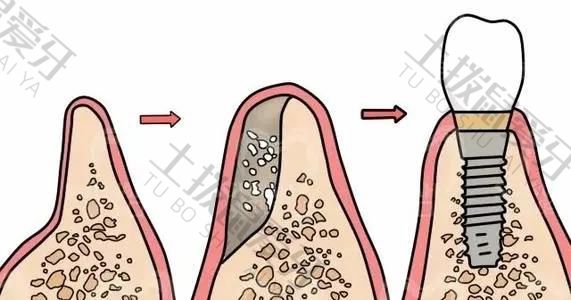 种植牙植骨后会肿吗