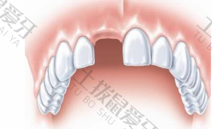 拔牙后可以不种植牙吗