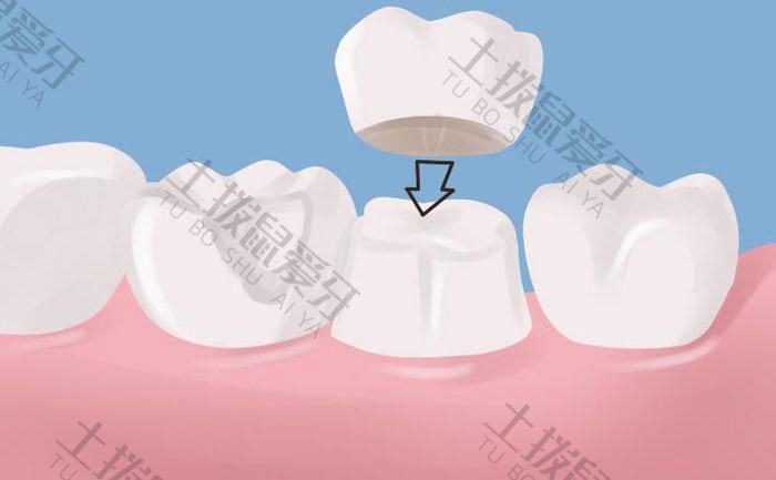 种植牙牙冠怎么安装