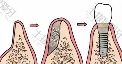 种植牙植骨后会肿吗 植骨种植牙的过程步骤