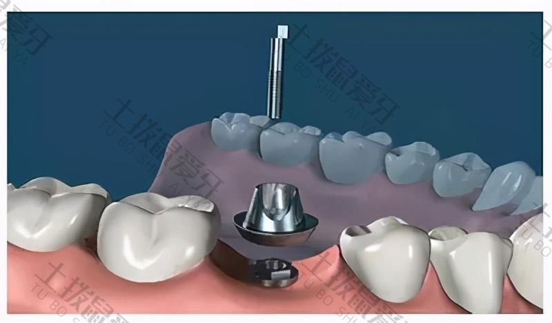 什么是即刻种植牙