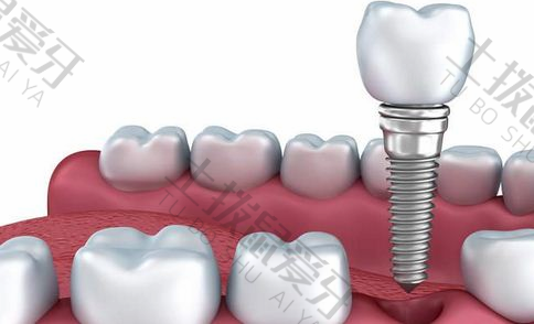 即刻种植牙的优缺点