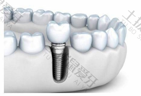 种植牙最快多长时间