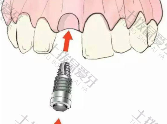 种植牙要多长时间才能种好