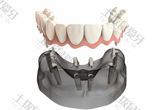 老人种植牙全口多少钱