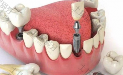 种植牙植骨粉注意事项 种植牙手术后注意事项