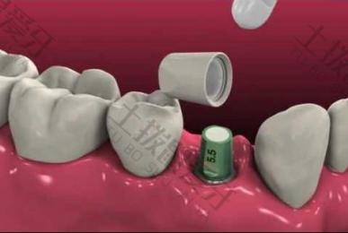 种植牙后牙龈肿痛怎么办 种植牙后牙龈肿胀什么时候消肿