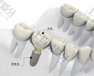 种植牙可以即拔即种吗 种植牙社保可以报销吗