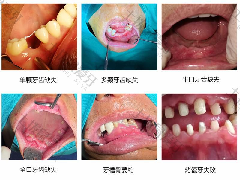 种植牙手术后疼痛难忍正常吗