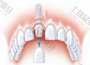 种植牙后牙龈肿痛会引起脸痛吗 种植牙后牙龈肿正常吗