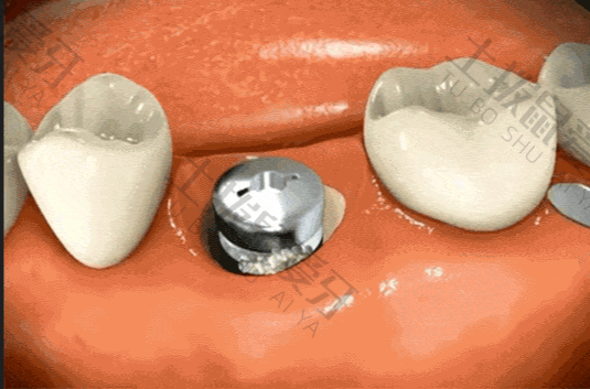种植牙手术怎么做
