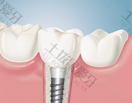 拔牙两年后再种植牙齿有问题吗