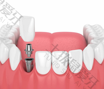 门牙需要种植牙吗
