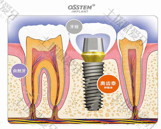 登腾种植牙好还是奥齿泰种植牙好