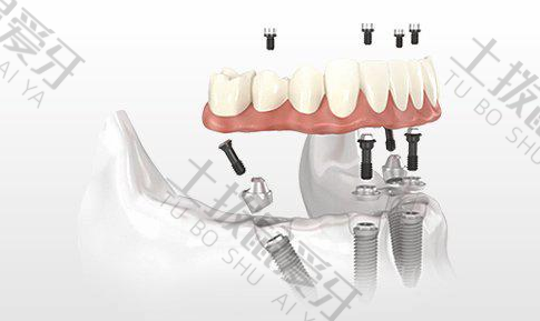 全口种植牙价格是多少钱一颗