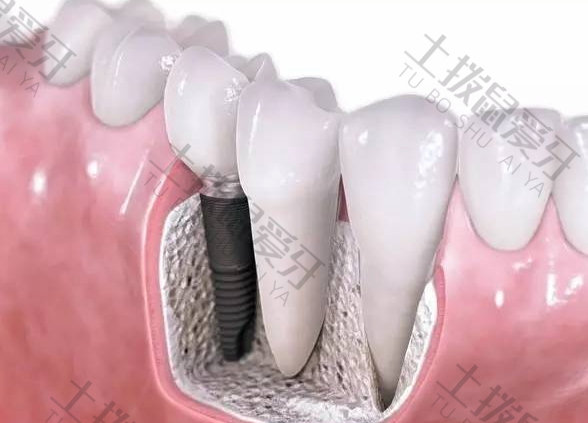 种植牙二期手术过程会感染吗
